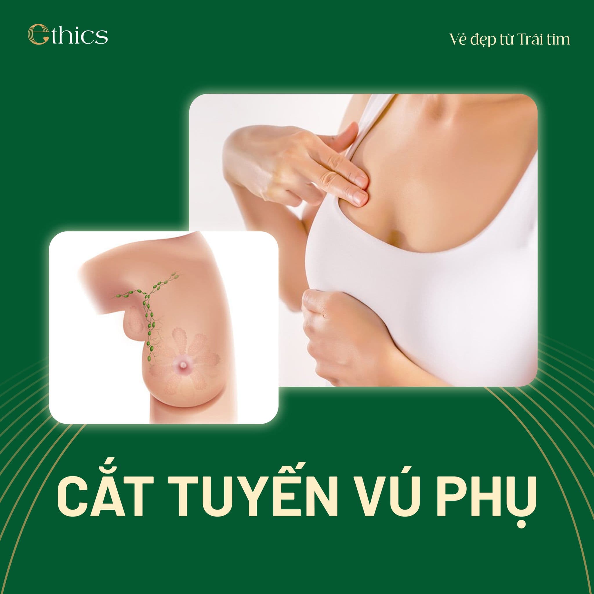 ការកាត់ក្រពេញទ្រូងបន្ថែម