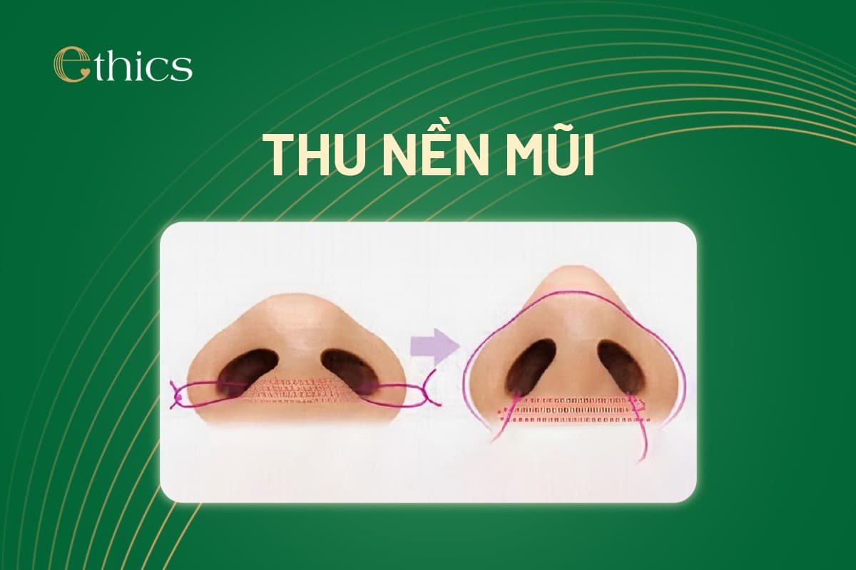 ការកាត់បន្ថយទំហំច្រមុះ