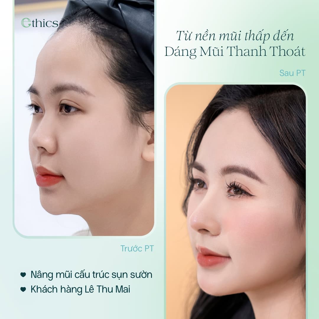រូបភាពករណីស្ពាន់ច្រមុះតាមរចនាសម្ព័ន្ធសន្លាក់ឆ្អឹងជំនីររបស់ Lê Thu Mai ដែល Ethics បានបង្ហោះថ្ងៃទី 20/09/2026