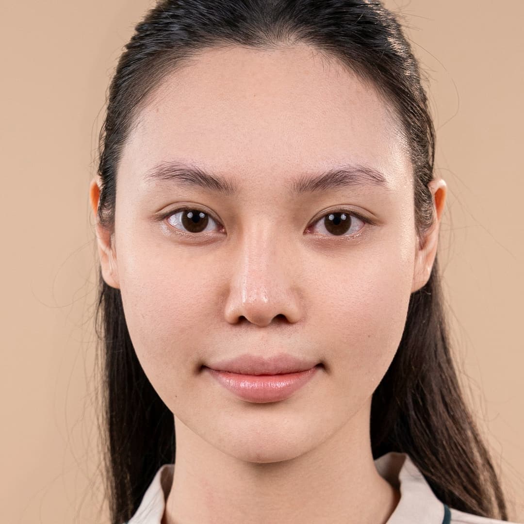 អតិថិជន Lưu Phương Anh - មុនការអន្តរាគមន៍កែច្រមុះ One fit