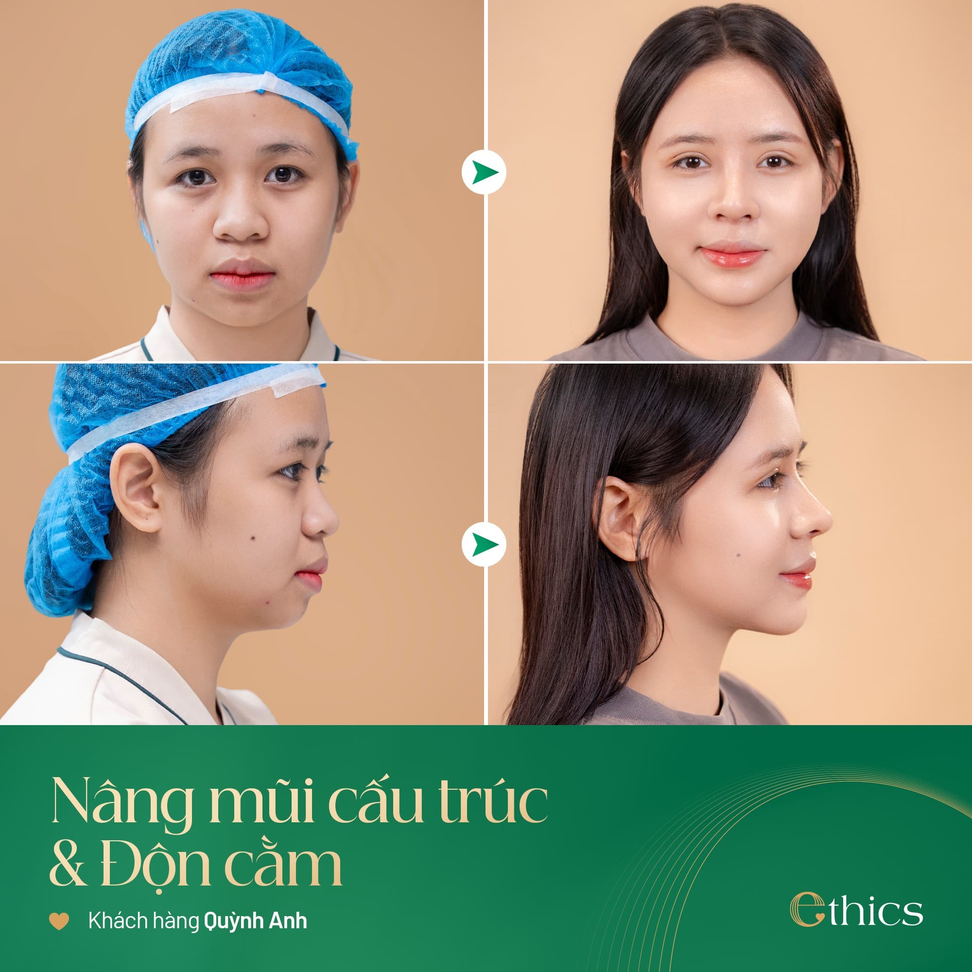 ការកាត់បន្ថយចិញ្ចើមថ្មើមដោយផលិតផល Ethics (Softxil)