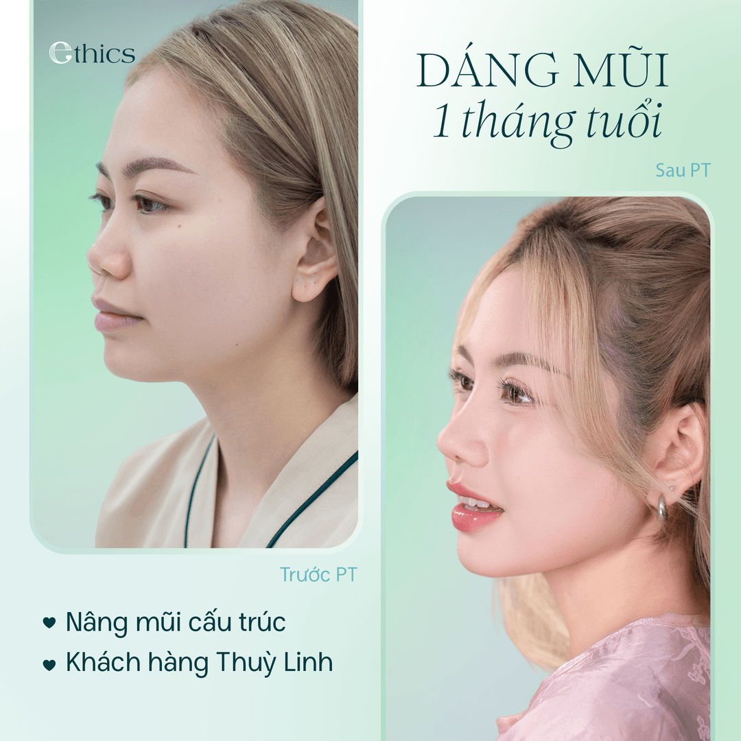 រូបភាពប្រៀបធៀបមុន និងក្រោយការកែច្រមុះដោយរចនាសម្ព័ន្ធរបស់អតិថិជន