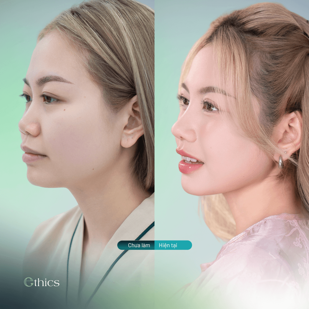 រូបភាពសមាមរិទ្ធيةដែលបង្ហាញពីមុខមាត់របស់អតិថិជន មុន និងក្រោយពេលទទួលការកាត់បន្ថយច្រមុះ