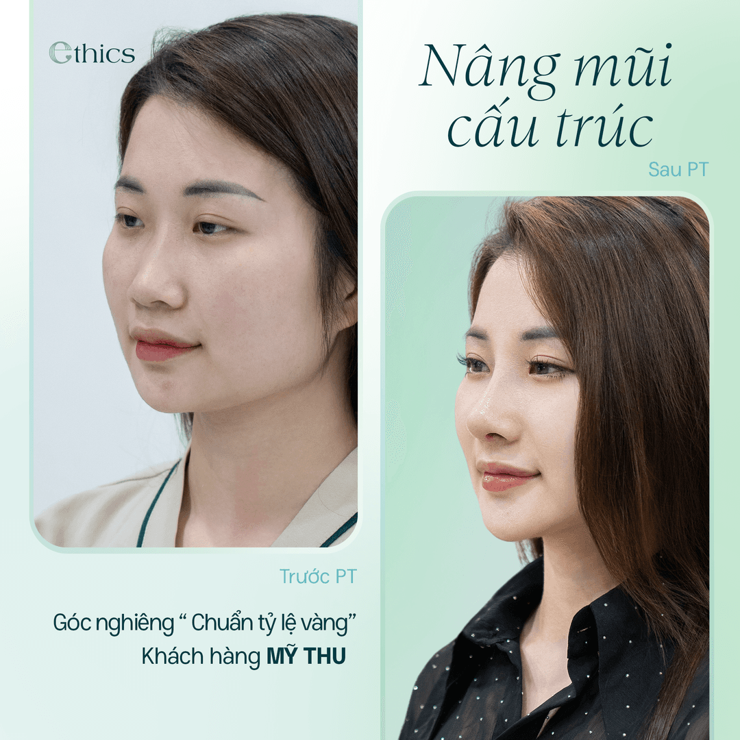 ការប្រៀបធៀបរូបភាពមុន និងក្រោយពេលដែលអនាស្ត្រីបានទទួលការកាត់បន្ថយច្រមុះ