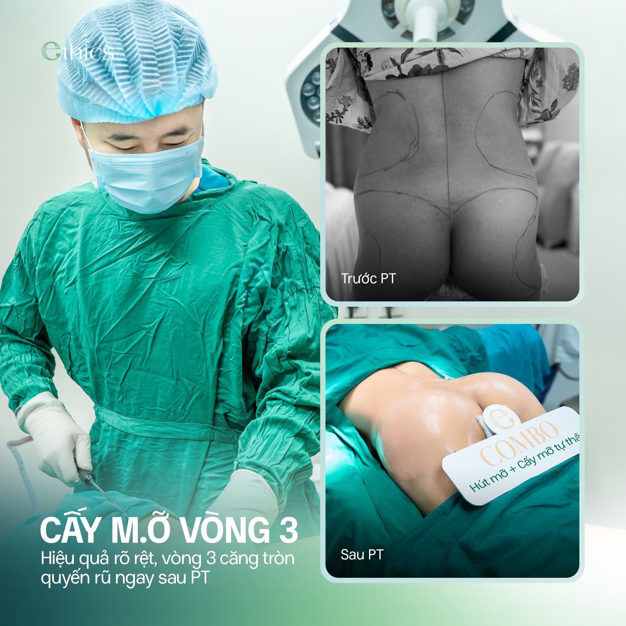 CẤY MỠ TỰ THÂN VÒNG 3 - CÂN CHỈNH TỶ LỆ, HOÀN THIỆN ĐƯỜNG CONG