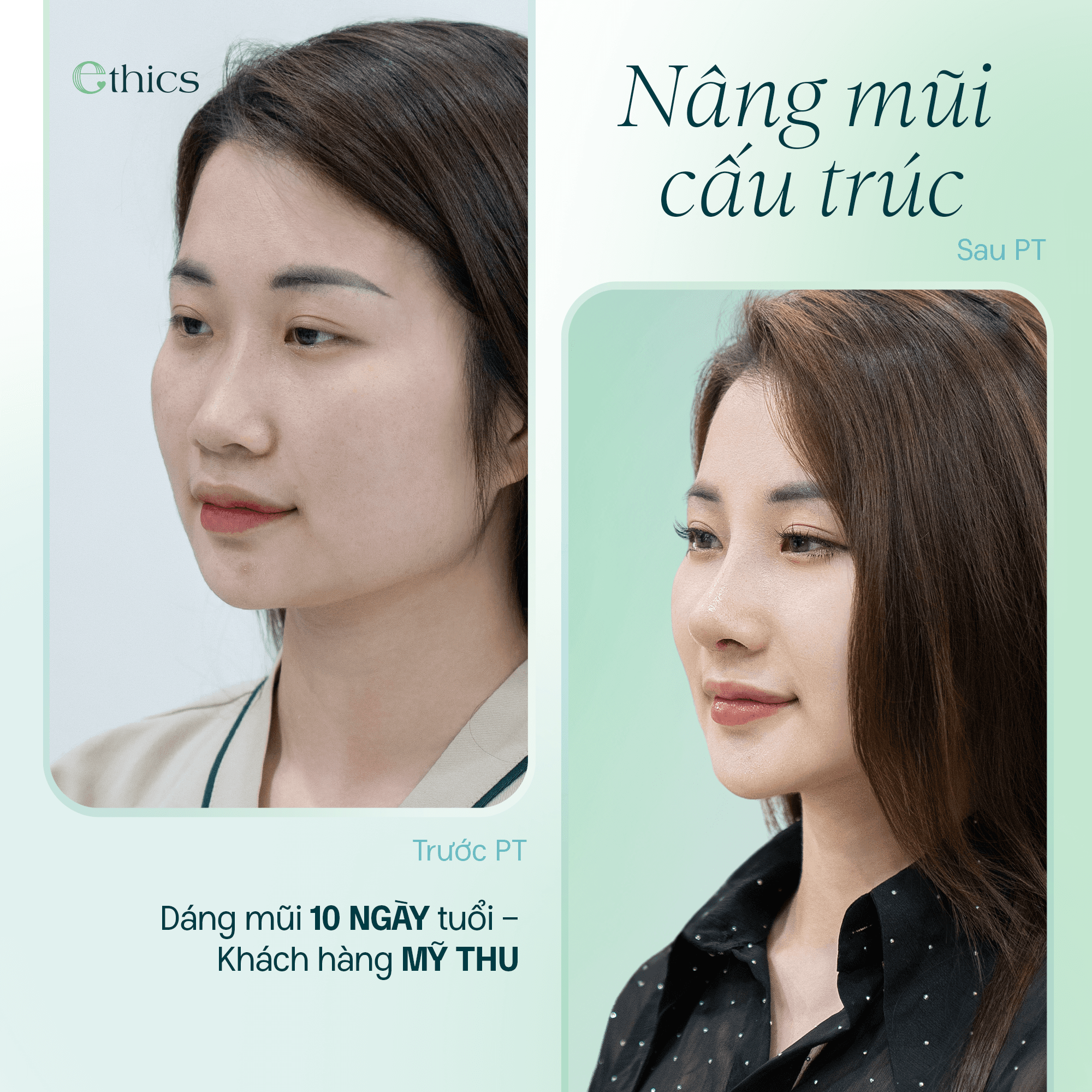 So sánh trước và sau khi nâng mũi cấu trúc của khách hàng